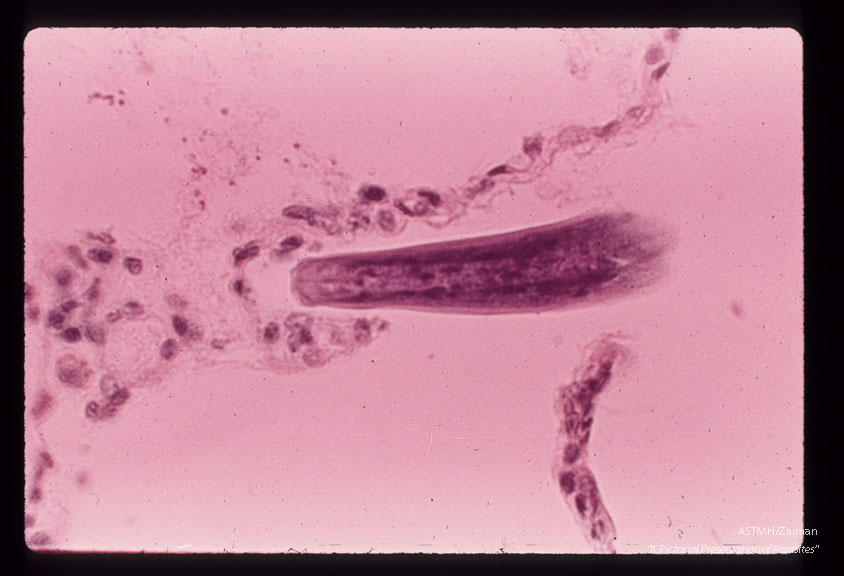Larvae in alveoli.