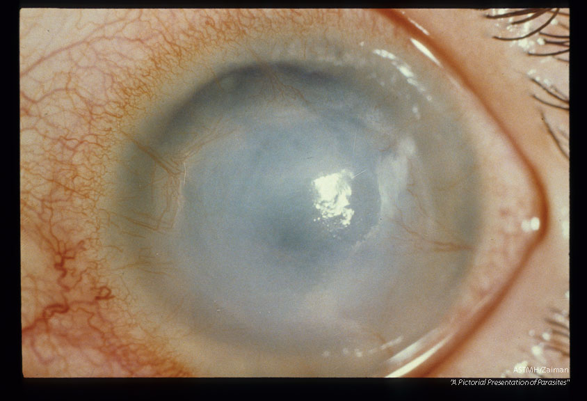 Keratitis in the eye of a different patient.