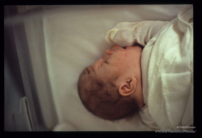 Hydrocephalus in an infant from Illinois.