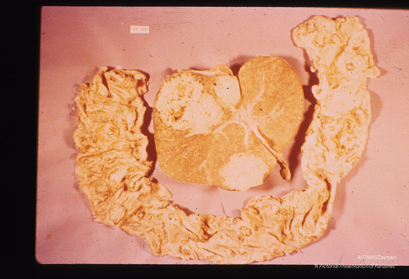 Formalin fixed specimen of gut, showing ulcers and liver showing abscesses.