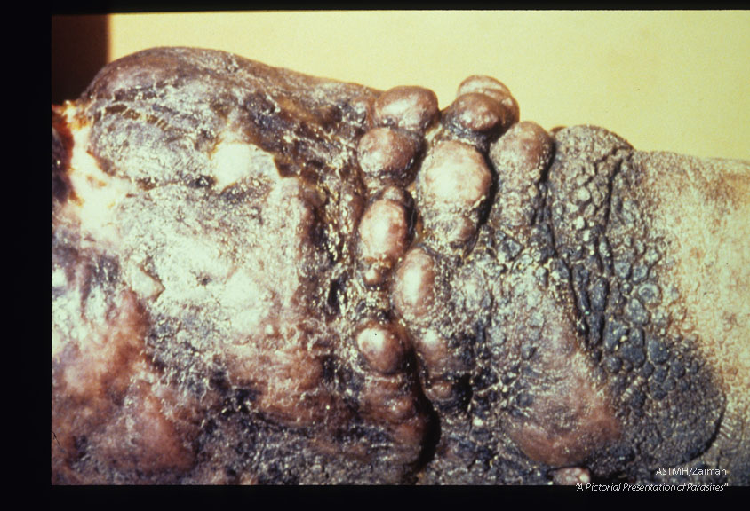 Elephantiasis, penetrating ulceration, heavy verrucal hyperkeratosis ("mossy foot"), and nodules on the left leg of a seventy-four year old male. Close-up slide shows the back of the leg just above the heel. Swelling began thirty years ago and ulceration nine years ago. Skin is armor-like and cracked in places. Leg is foul smelling and oozes a material like purulent lymph.