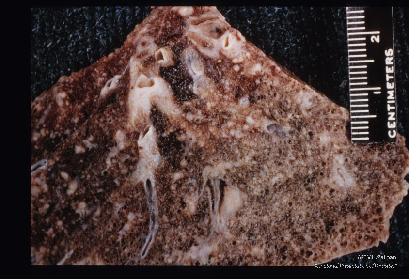 Gross pathology. Lung slices showing pseudotubercles in fatal pulmonary schistosomiasis.