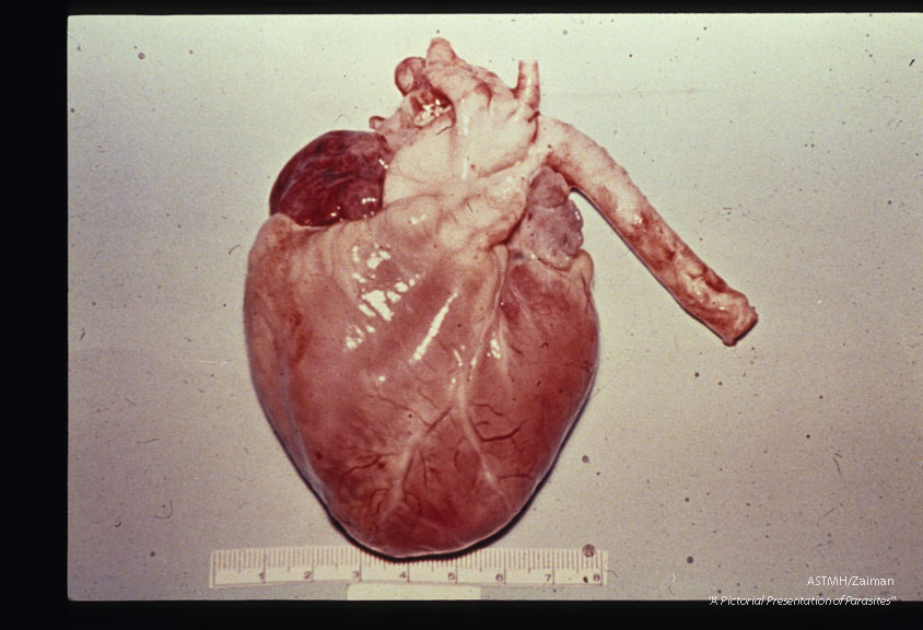 Heart showing typical pale, wet, flabby, swollen appearance due to myocarditis.