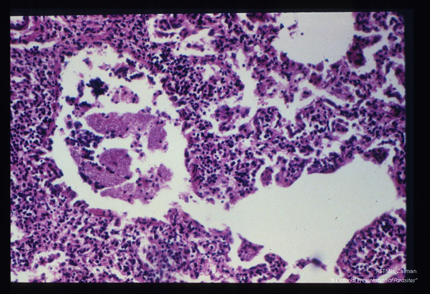 Pneumonia. The alveolar spaces contain honeycomb material. A lining of pinkish red material defines the alveolar space. Note the thickened alveolar walls which are intensively invaded by plasma cells and lymphocytes.