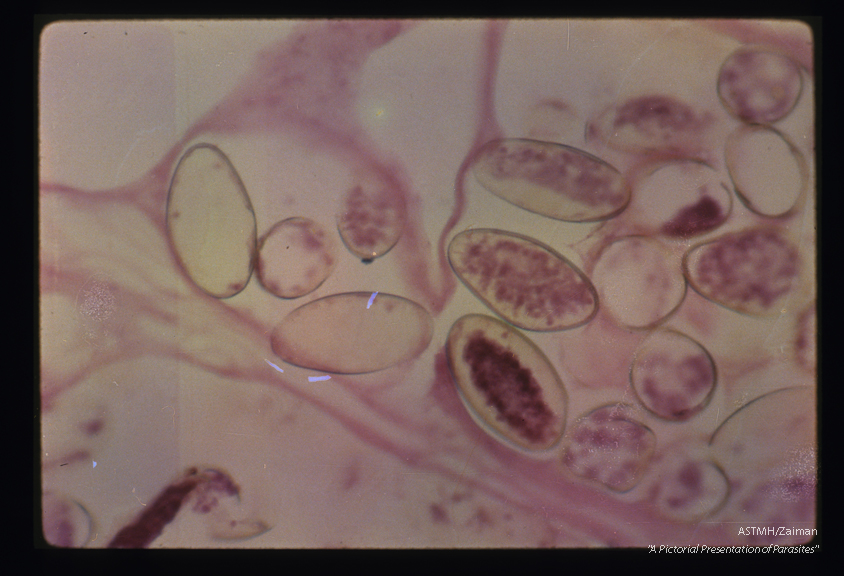 Eggs in adult within a bile duct. These eggs are larger than those of Clonorchis; they are more oval and have an operculum which appears practically continuous with the rest of the egg shell.