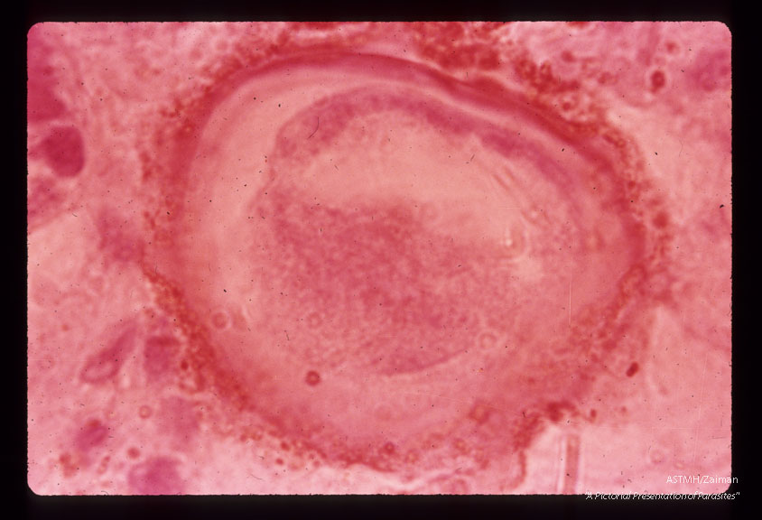Egg in lung.