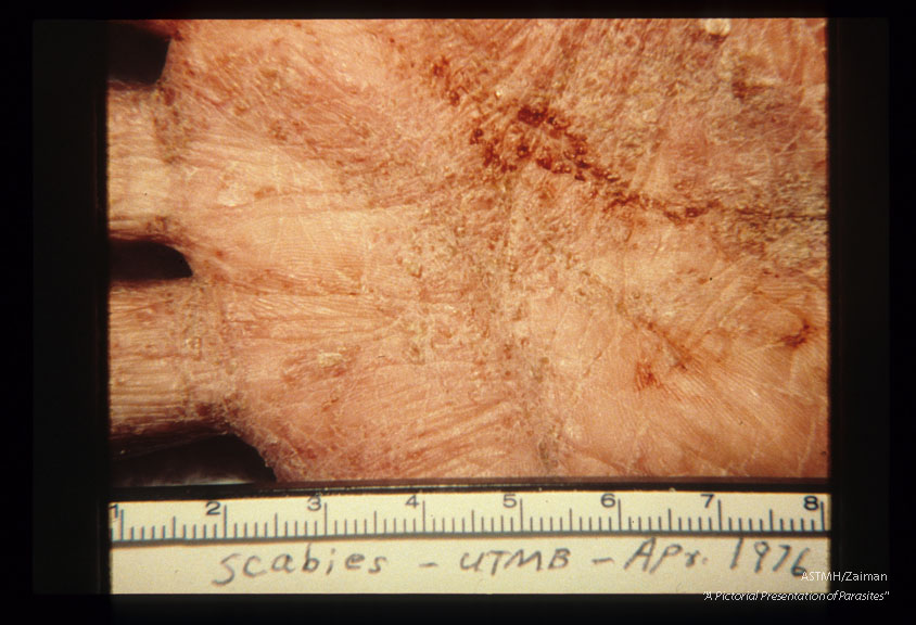 Severe lesions of the hand.