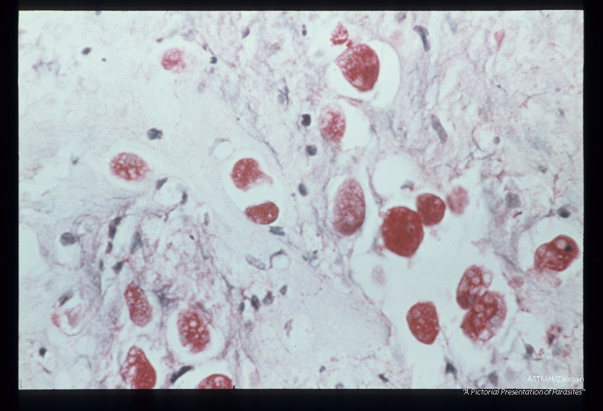 Best carmine stained section of rectum. Note cytolysis around amoebas.