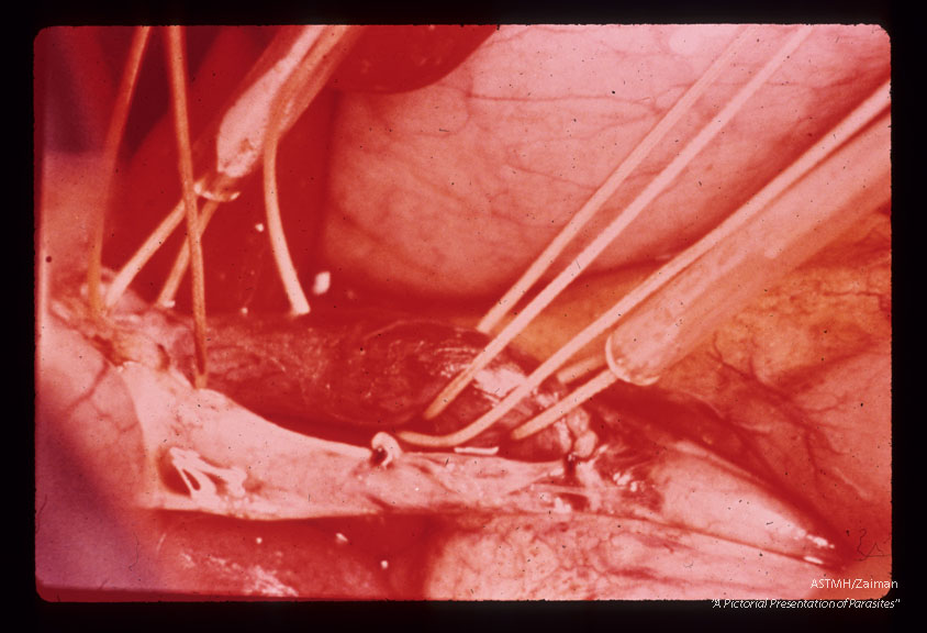 Mobilization of hepatic vein and insertion of tubing leading to bypass filter.