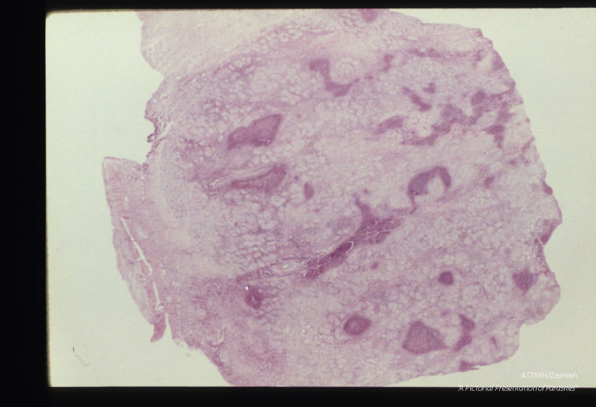 Five year old male. Testicle showing multiple eosinophilic infiltrates at various magnifications.