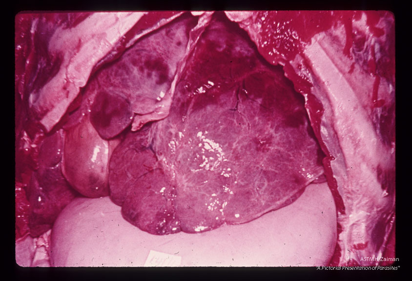 Autopsy specimen of 27 year old Brazilian male who died of hematemesis associated with hepatosplenomegaly. One hundred-eighty-three active adult pairs were counted at autopsy. The external surface of the liver was bosselated. Although this was the most typical appearance, the liver surface is sometimes smooth or finely nodular in such cases.