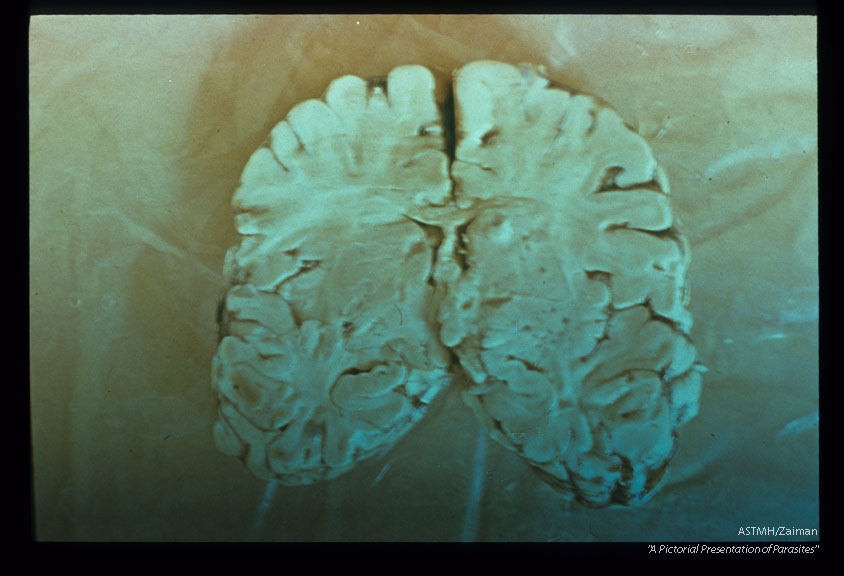 A macroscopic view of the brain of same patient showing cysticerci. There is an easily visible cyst in one of the temporal lobes.