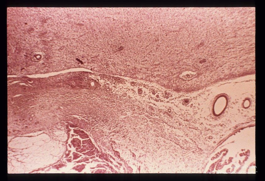 Toxoplasmic encephalitis showing transition of ependymal ulceration to full-blown periventricular necrosis.