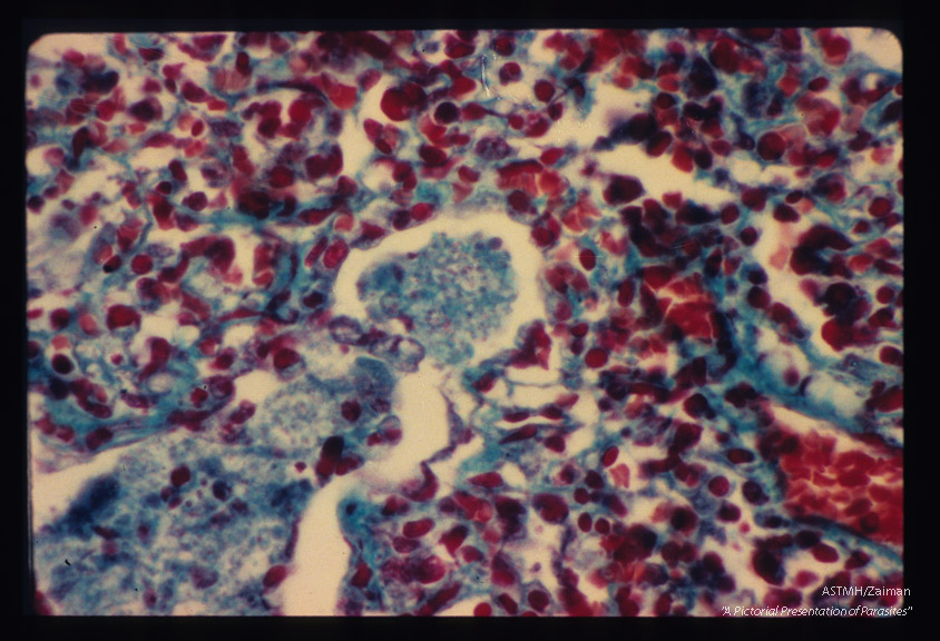 Pneumonia. Higher magnification of infected lung stained by Wheatly modification of trichrome stain for stools showing "honeycomb" ma­terial in alveoli. Parasites are also seen and oc­casionally nuclear material is visible within the parasites.