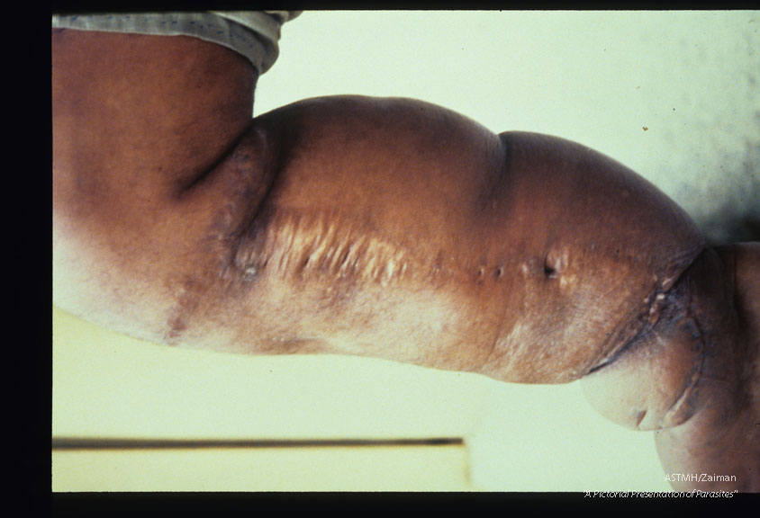 Medial aspect of right leg of thirty-three year old male. The case was acquired twenty-three years ago. The scar is from a Thompson operation (buried dermal flap). Photographed during admission to hospital prior to a lateral Thompson procedure on the same leg.