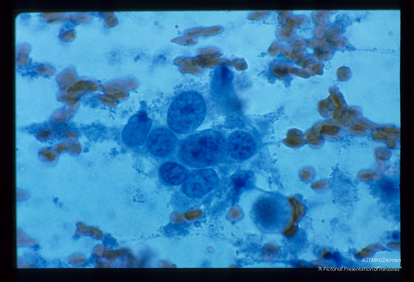 Multiple Pap smear fields from the cervix of the same patient. Various magnifications.