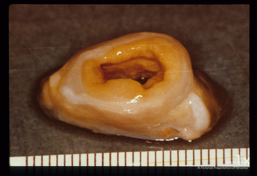 Dilated chimpanzee ureter with circumferential sandy mucosa.