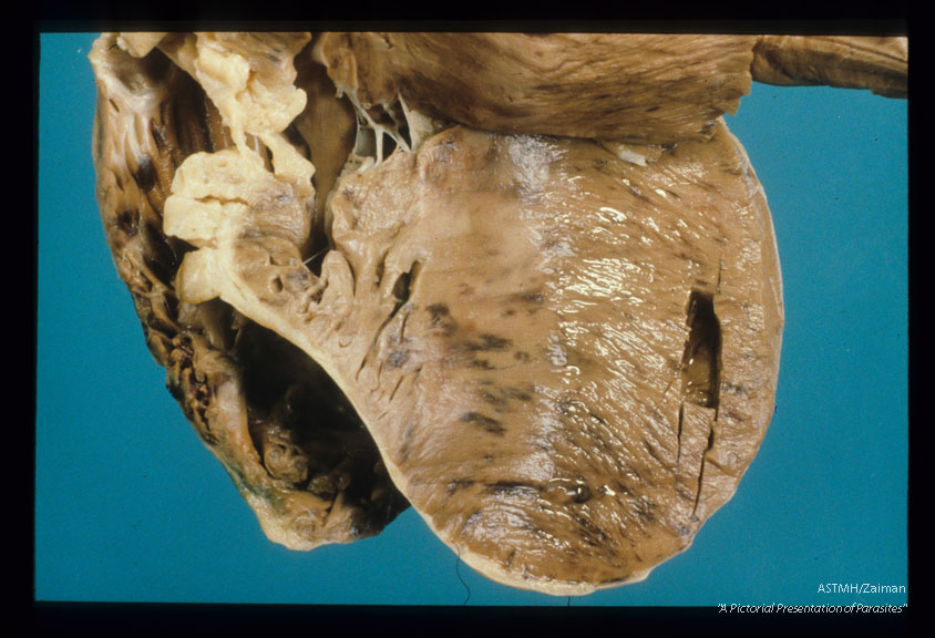 Heart showing hemorrhage and mesocercaria.