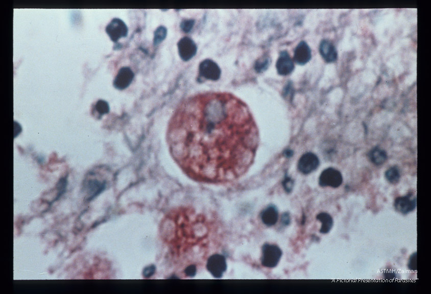Best carmine stained section of rectum. Note trophozoite with ingested red blood cell.