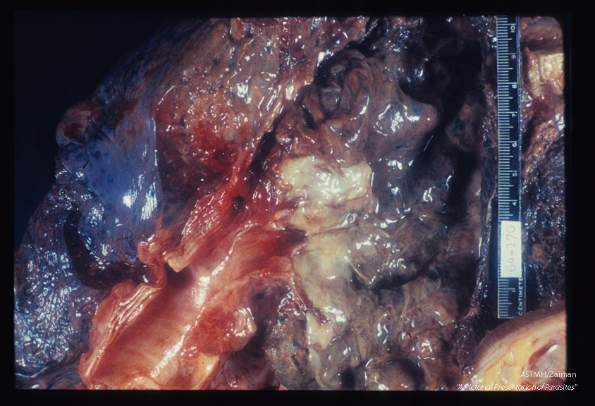 Hepato-pulmonary abscess communicating with bronchus.