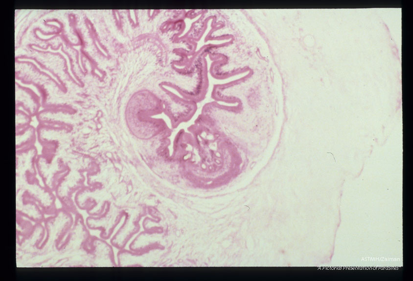 Photomicrographs of a subcutaneous nodule in a patient.
