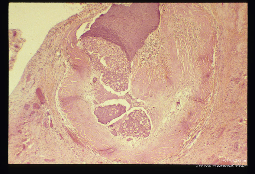 Ovarian enterobiasis.