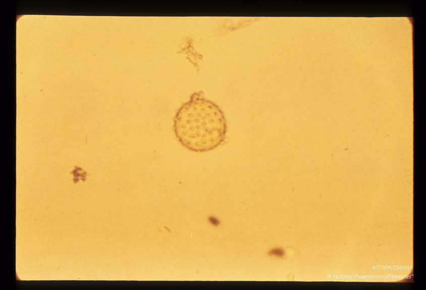 Pollen found in spinal fluid and misinterpreted as Ascaris egg.