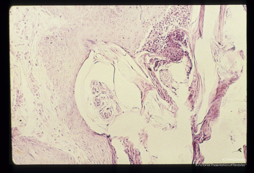 Section through skin showing burrowing mite.