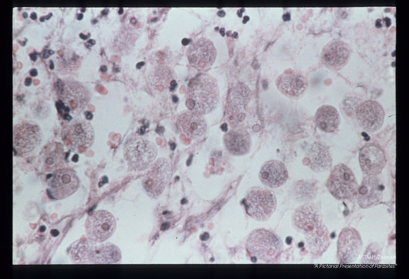 Hematoxylin-eosin stained section of rectum showing numerous parasites.