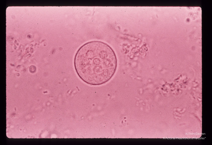 Cyst in feces. Iodine stained wet mount.