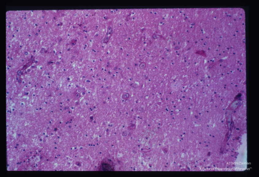 Brain showing glial proliferation and amoeba.