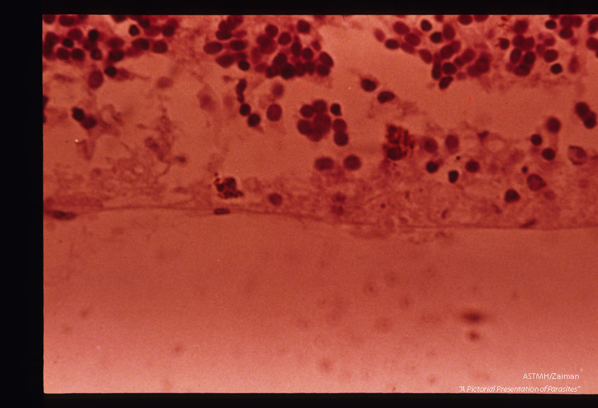 Toxoplasmic retinochoroiditis with Toxoplasma groups in center. H&E stain.