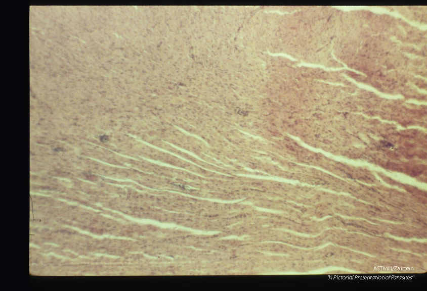 Diffuse inflamatory lesion. Experimental trichinous myocarditis in rats.