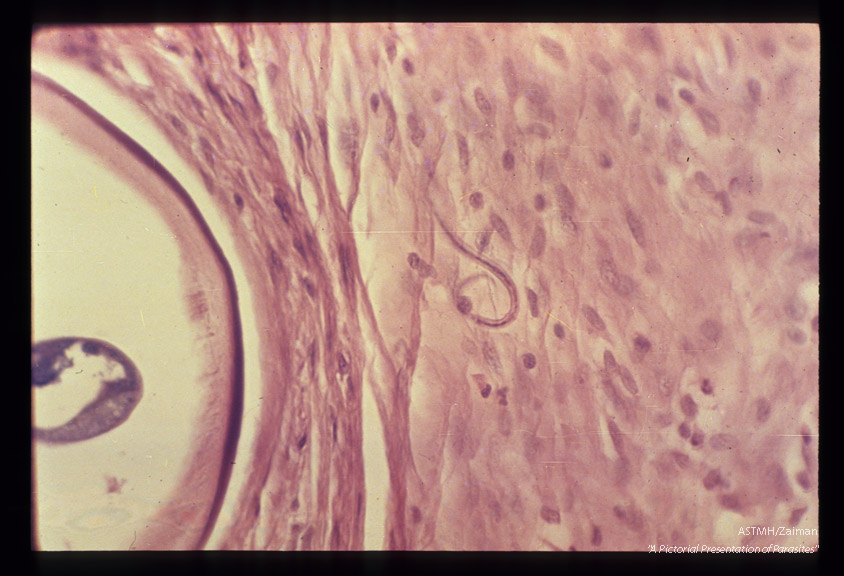 High power view showing microfilaria in nodule of fibrotic tissue adjacent to adult.