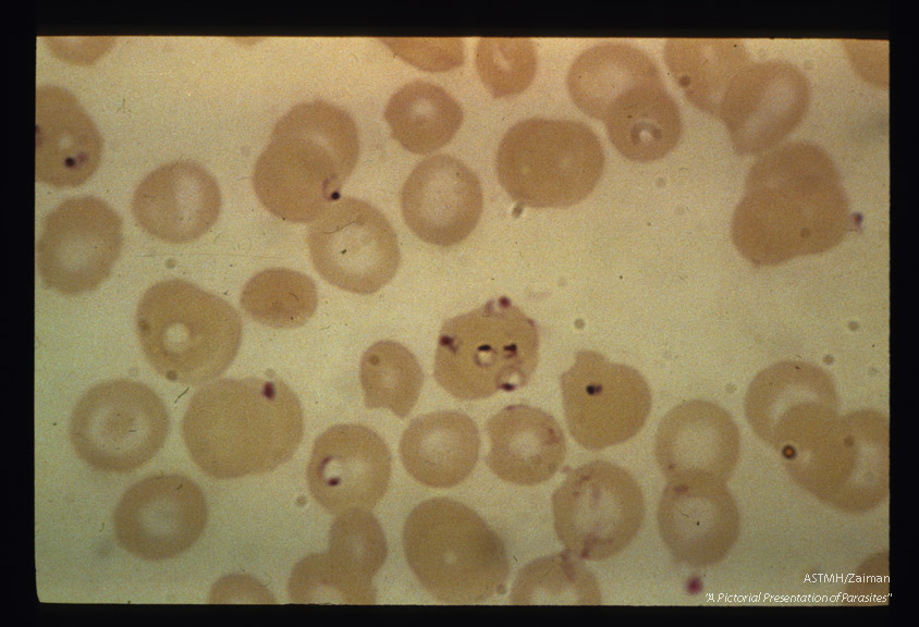 Severe infection with red blood cell harboring several parasites.