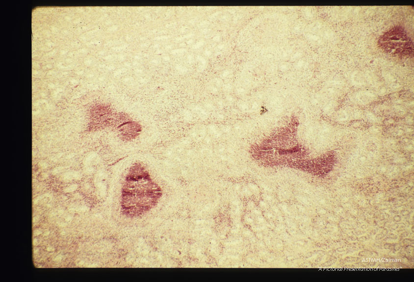 Five year old male. Testicle showing multiple eosinophilic infiltrates at various magnifications.