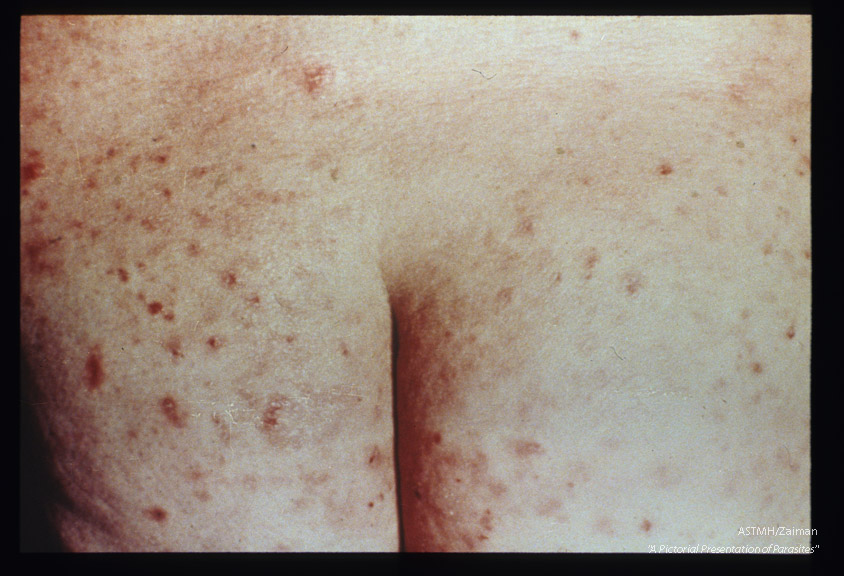 Dermatitis over buttocks.