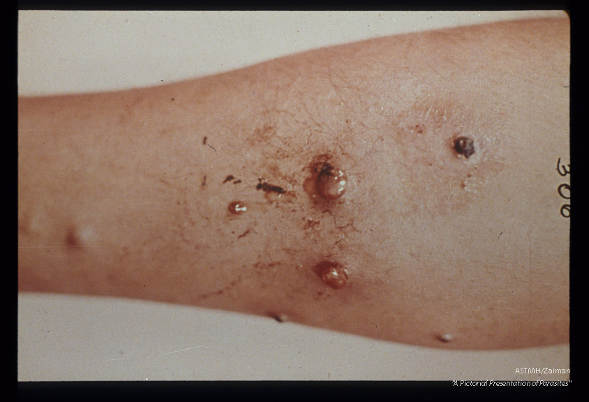 Hematogenous nodular type verrucous eruption on leg.