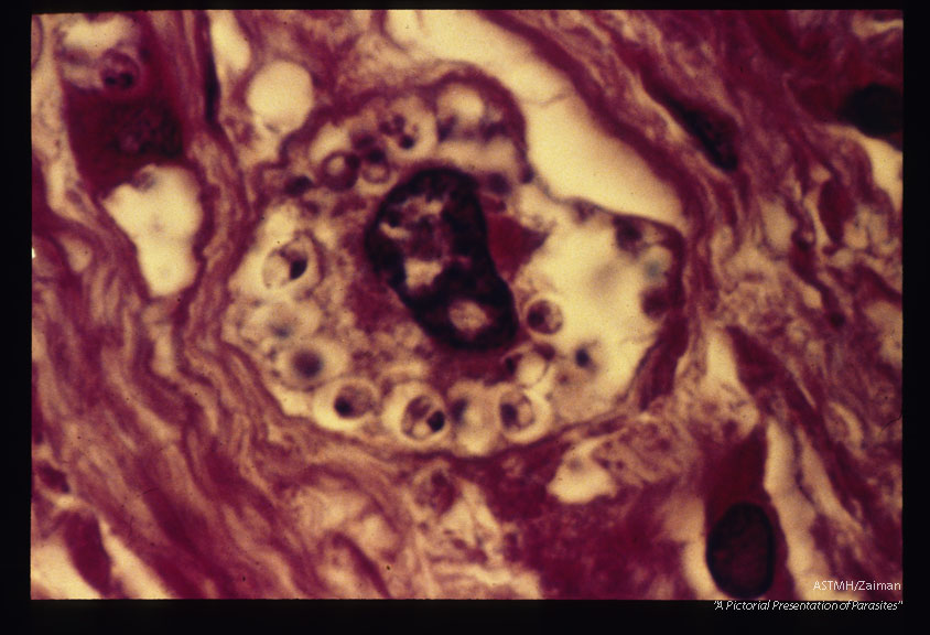 A giant cell containing many amastigotes is present in the placental choron.