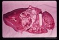 Autopsy specimen showing abscess involving liver and diaphragm resulting from migrating adult ascarids. One transected adult ascarid protrudes from a bile duct.