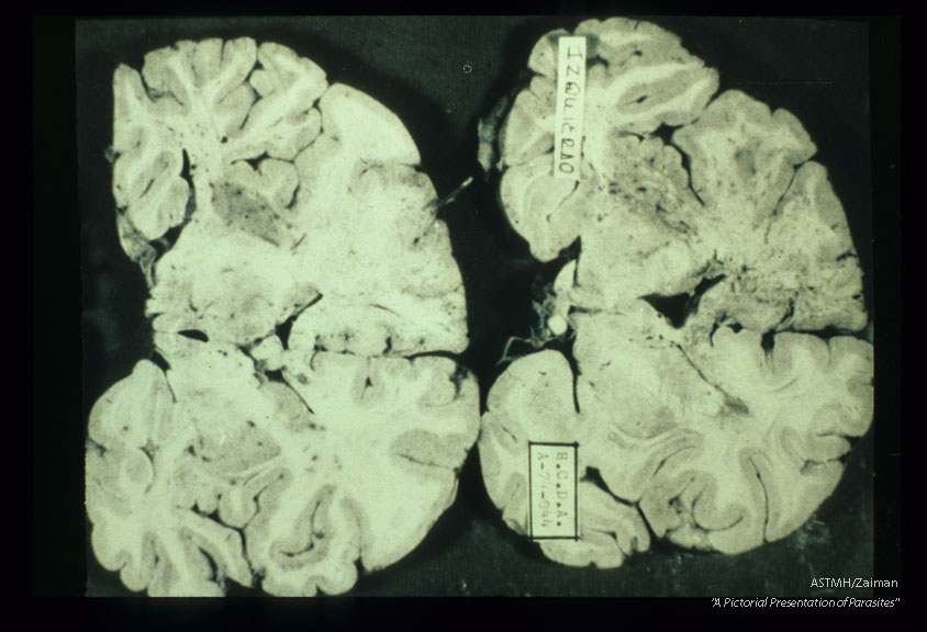 Brain slices showing massive destruction due to granulomatous amoebic encephalopathy.