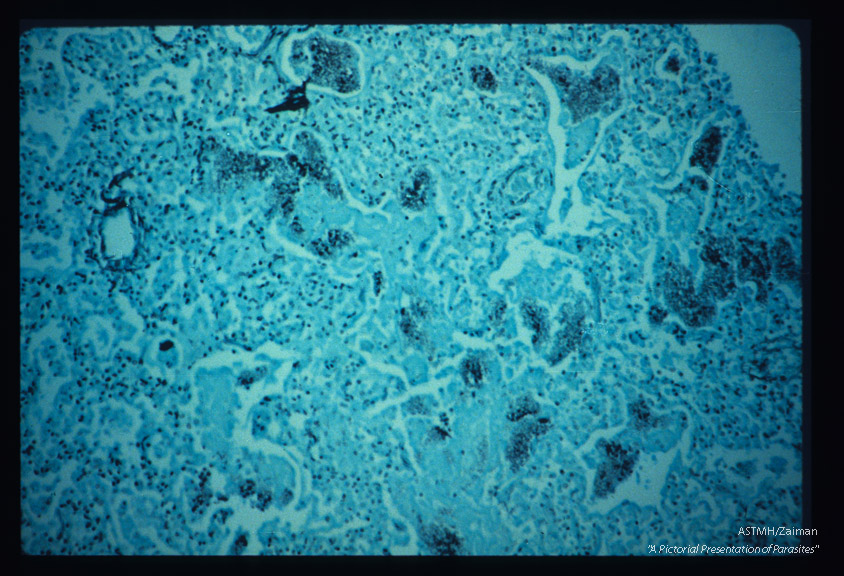 Pneumonia. High power view of infected lung stained with silver methenamine. Parasitic borders are often sharply outlined in black. Fewer nuclei are seen.