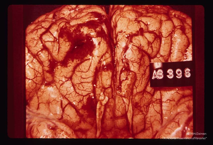 Lee case of primary amoebic meningoencephalitis. Whole brain.