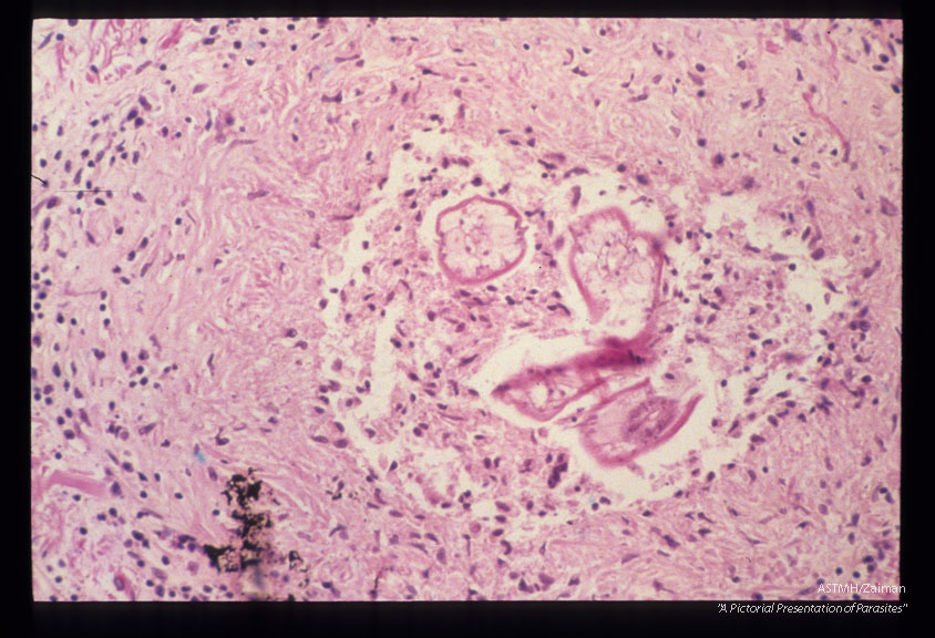 Same case. Larval granuloma in brain.