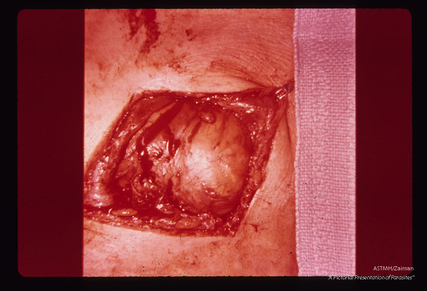 Incision of tissues overlying cyst wall.