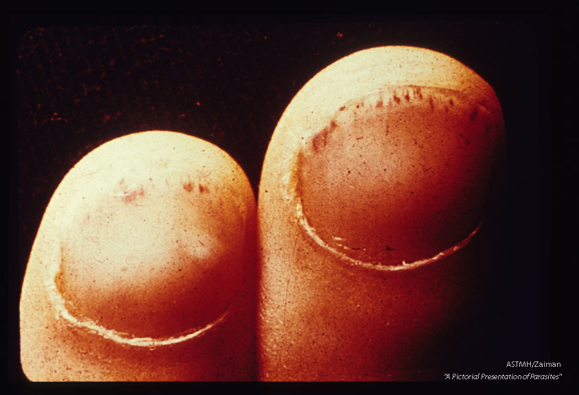 Subungual splinter hemorrhages in trichinosis.