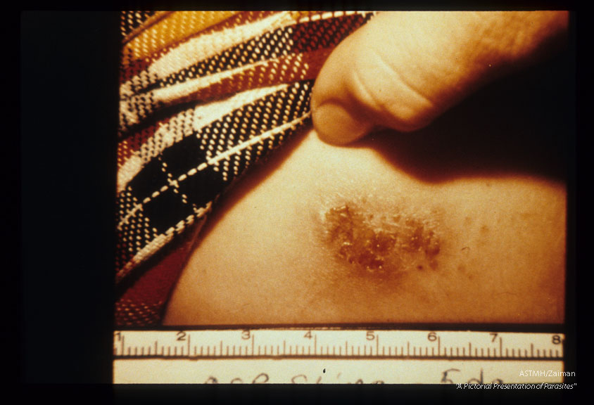 Evolution of dermatitis produced by venom introduced into human skin by hollow larval poisonous spines. Five days after exposure.