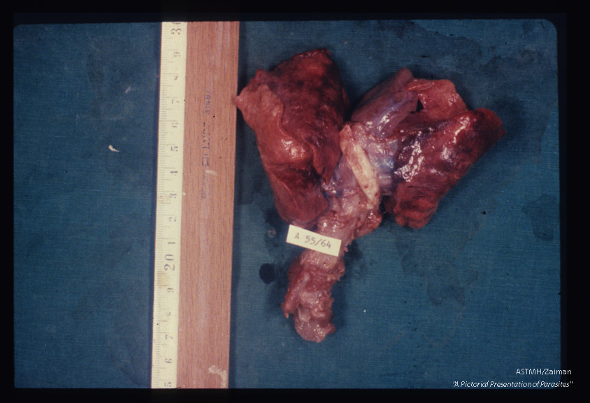 Lungs from infant dead from Pneumocystis pneumonia showing the characteristic brick red color and grooves due to rib pressure on expanded lungs.