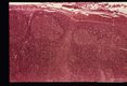 Toxoplasma lymphadenitis with lymphoreticular hyperplasia. H&E stain.