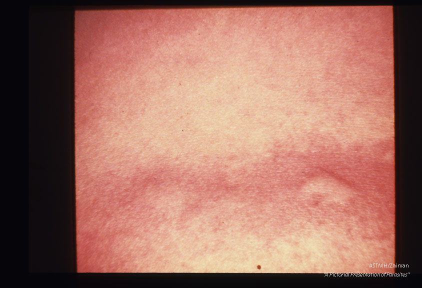 Linear, migrating, urticarial, pruritic rash on abdomen of patient suffering chronic infection.